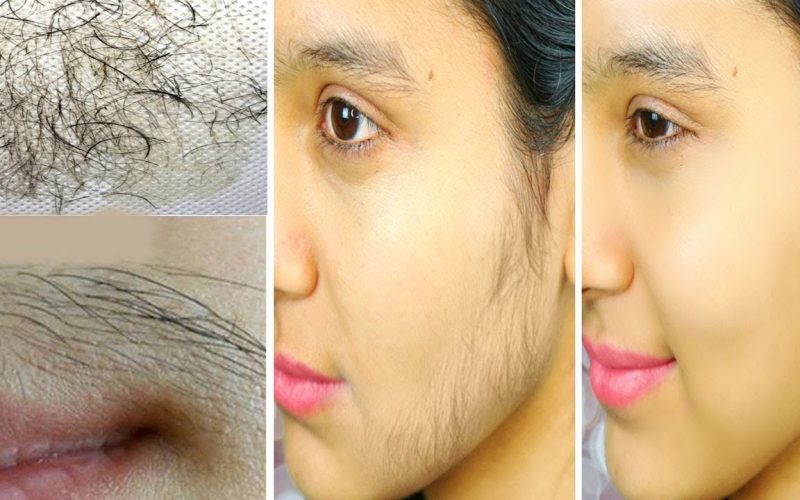 خلطة النشا الرهيبة لإزالة شعر الوجه الزائد بالكامل بدون أي ألم وبطريقة سهلة